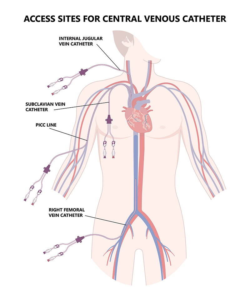 Tunnelled Central Venous Line